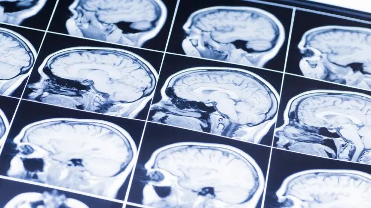 Kanker Otak atau Glioblastoma Paling Ganas?