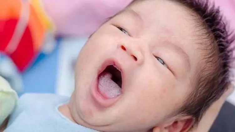 Sebab Gagal Bentuk Bibir dan Lelangit pada Anak