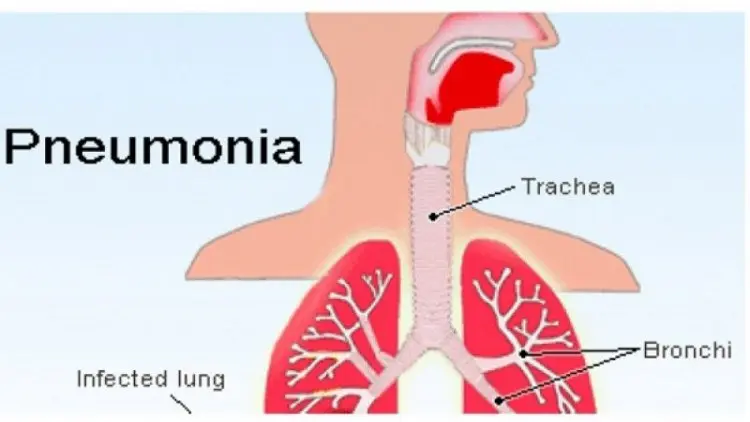 KBRI Beijing Pastikan Tak Ada WNI Terjangkit Wabah Pneumonia Berat