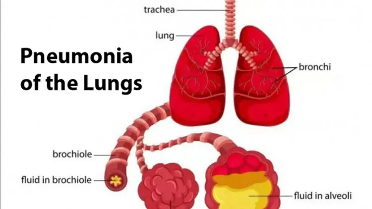 Beijing Temukan Dua Kasus Pneumonia Baru, di Wuhan Tiga Meninggal