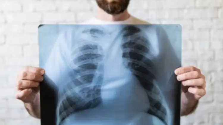 Penting! Ini Lima Cara Terhindar dari Tuberkolosis