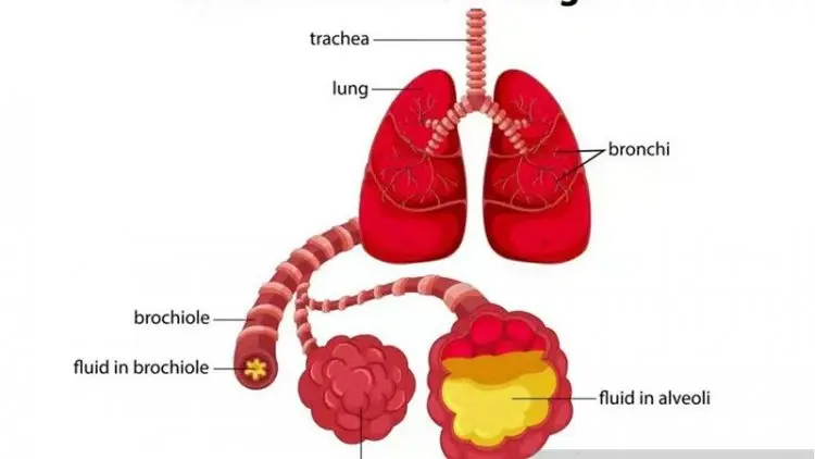 Yuk Kenali Gejala Tak Khas Pneumonia pada Lansia