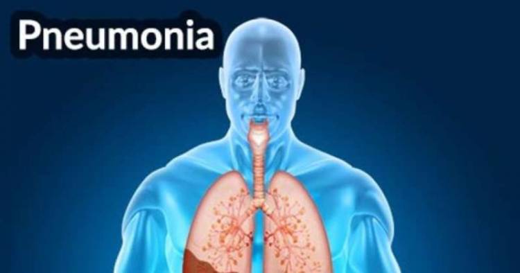 Mengenal Lebih Dekat Pneumonia