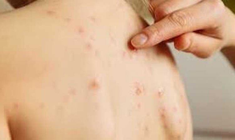 Inilah Pencegahan Penyakit Mongkeypox